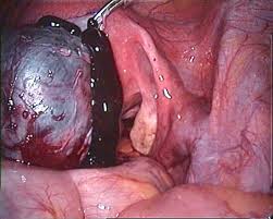 endometriozis-nedi