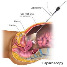 laparoskopi