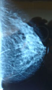 mamografinezamanvenesiklikta